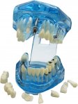 Verk 01964 Model zubných implantátov modrá