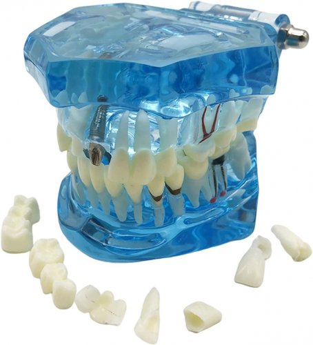 Verk 01964 Model zubných implantátov modrá