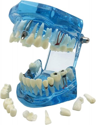Verk 01964 Model zubních implantátů modrá