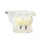 Verk 01964 Model zubných implantátov biela