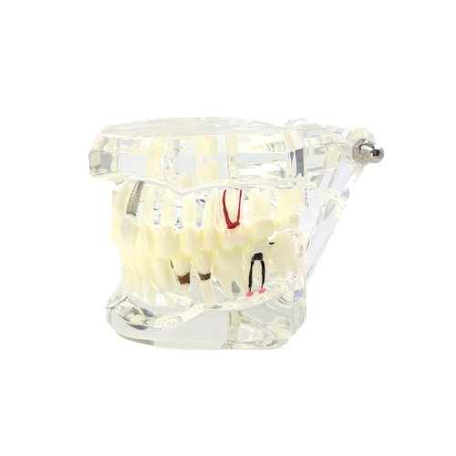 Verk 01964 Model zubných implantátov biela